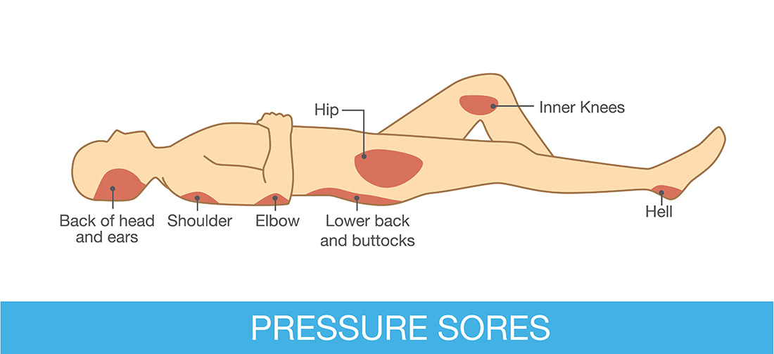 pressure wounds ulcers snf